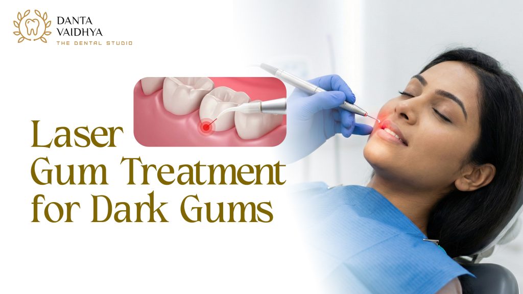 laser gum treatment for dark gums