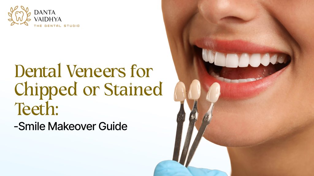 Dental Veneers for Chipped or Stained Teeth